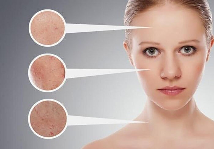 Mụn cám là những nốt mụn li ti xuất hiện thành từng cụm trên da