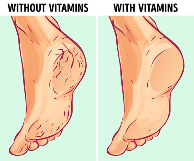 Nứt gót chân là tình trạng bong tróc, nứt nẻ phần da ở gót chân