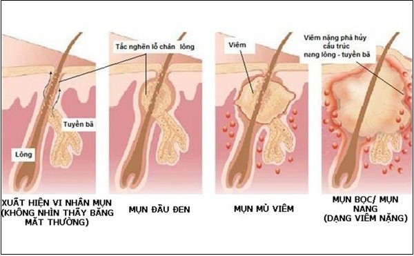 Sự bít tắc cổ nang lông gây ra mụn.
