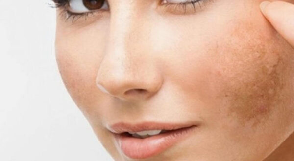 Nám da thường xuất hiện theo một vùng da.
