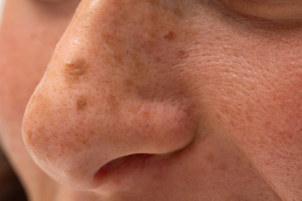 Mụn cám vùng mũi xuất hiện ở rất nhiều ở tình trạng khác nhau