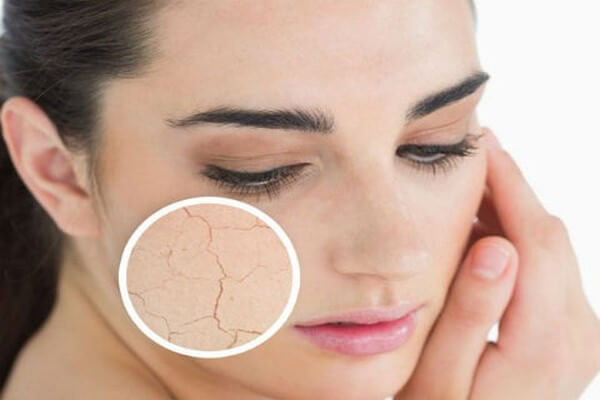 Việc lạm dùng các hoạt chất mạnh đặc biệt trong điều trị mụn sẽ khiến da trở nên khô rát.