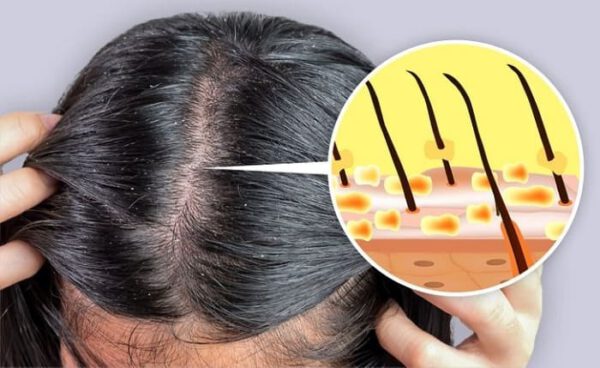 Tình trạng da đầu bị gàu và ngứa da dầu phổ biến.