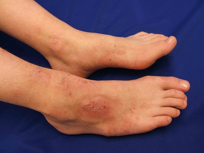 Eczema là bệnh ngứa da xảy ra khi thời tiết chuyển mùa. - nứt gót chân là thiếu chất gì