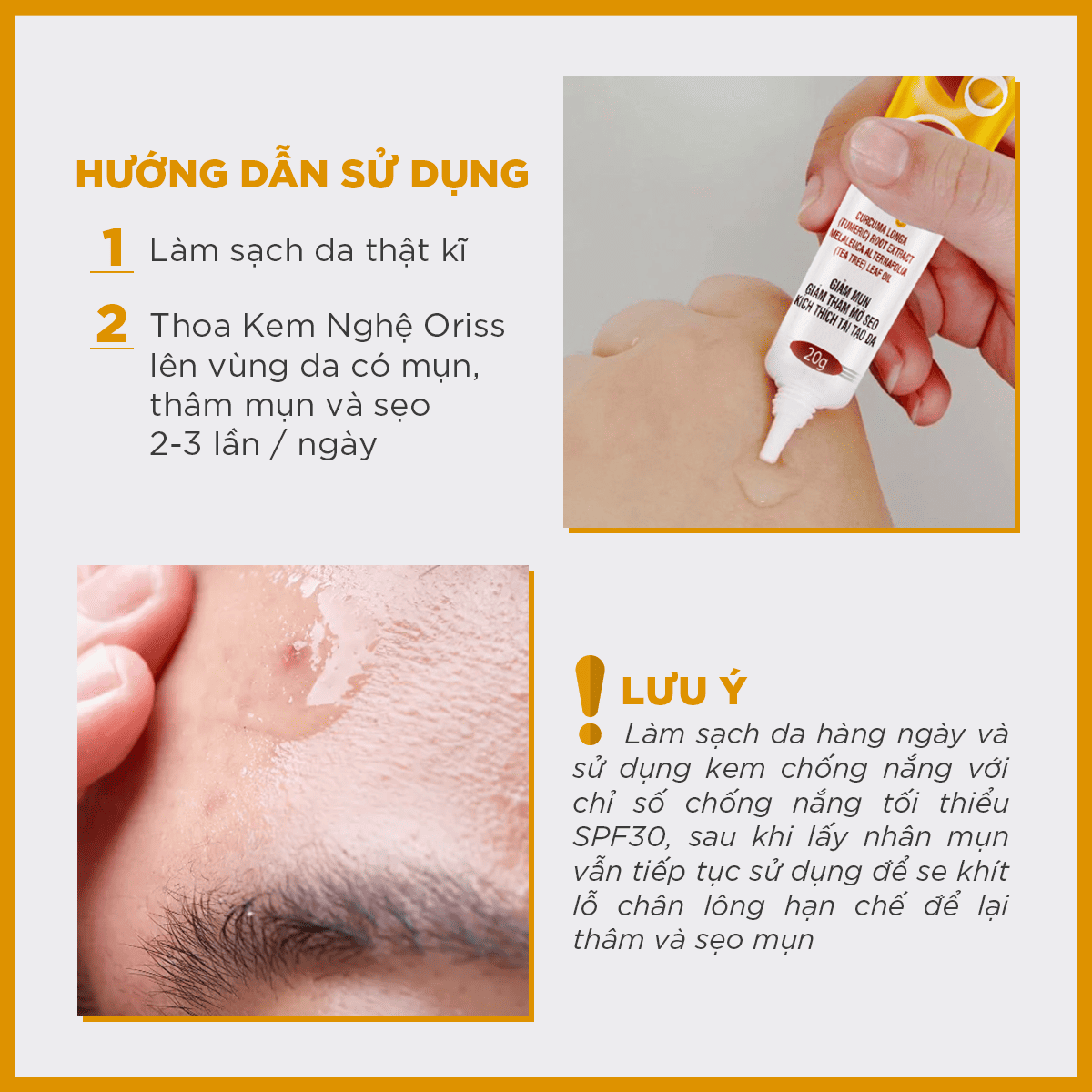 KEM NGHỆ ORISS - Giảm Mụn Mờ Thâm Liền Sẹo Kích Thích Tái Tạo Da - Tuýp 20g