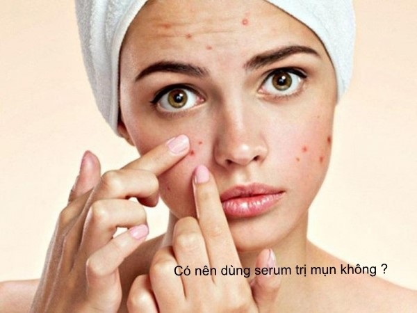 Bạn băn khoăn làn da dầu có nên dùng serum trị mụn không