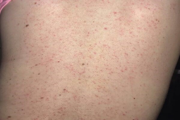 Đây là giai đoạn mà da vùng lưng bị viêm nang lông và dày sừng - kem trị mụn lưng