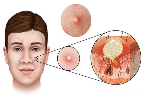 Hình thành mụn có chứa dịch mủ ở da mặt