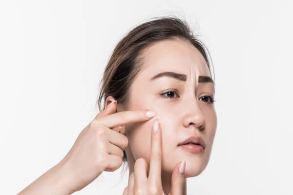 Hình thành mụn trứng cá khiến chúng ta trở nên mặc cảm