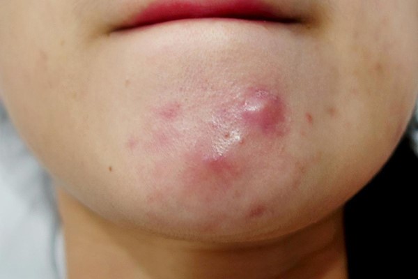 Hình ảnh của mụn bọc trên da