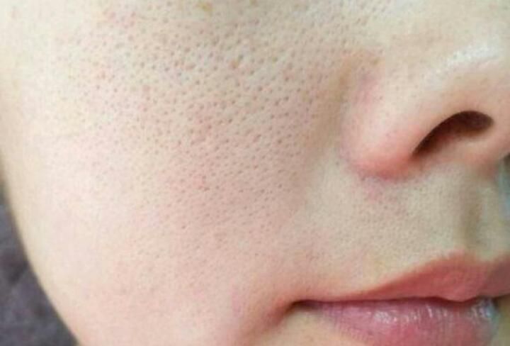 Lỗ chân lông to khiến da trông thiếu sức sống và gây mất thẩm mỹ - serum trị thâm se khít lỗ chân lông