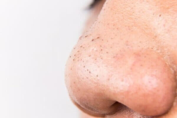 Mũi là nơi xuất hiện nhiều của loại mụn này - cách trị mụn đầu đen ở mũi