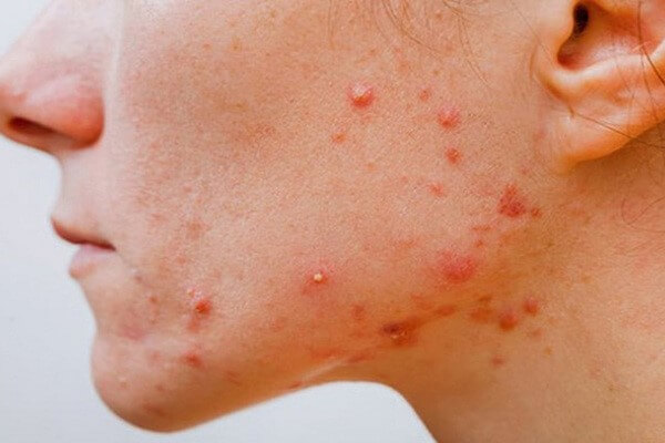 Mụn đỏ là vấn đề khá phổ biến ở nhiều người
