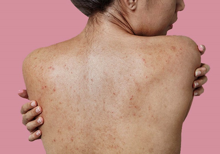 Mụn ở vùng da lưng - kem trị mụn lưng