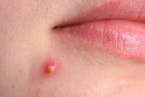 Mụn mủ có bề ngoài sưng đỏ chứa dịch mủ bên trong - kem trị mụn mủ