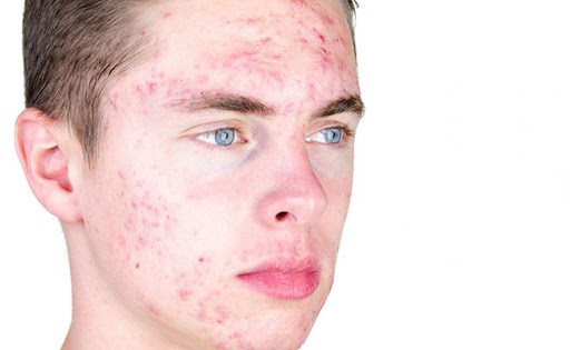 Mụn ở nam giới - serum trị mụn cho nam