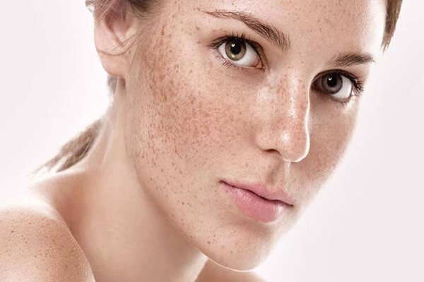 Nám da tình trạng trăn trở của nhiều phái đẹp - serum dưỡng trắng da trị nám