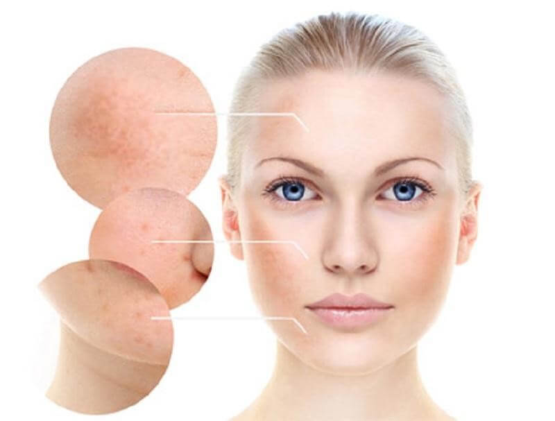 Nám da tuy không sậm màu như vết thâm mụn nhưng lại khó điều trị hơn - serum trị nám tốt