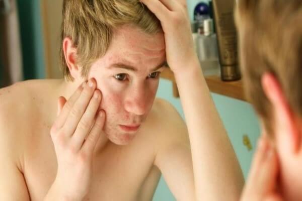 Ngoài mụn thì thâm sau đó cũng là nỗi lo âu của nhiều bạn nam