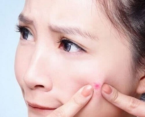 Nặn mụn sai cách gây ra tình trạng mụn thâm