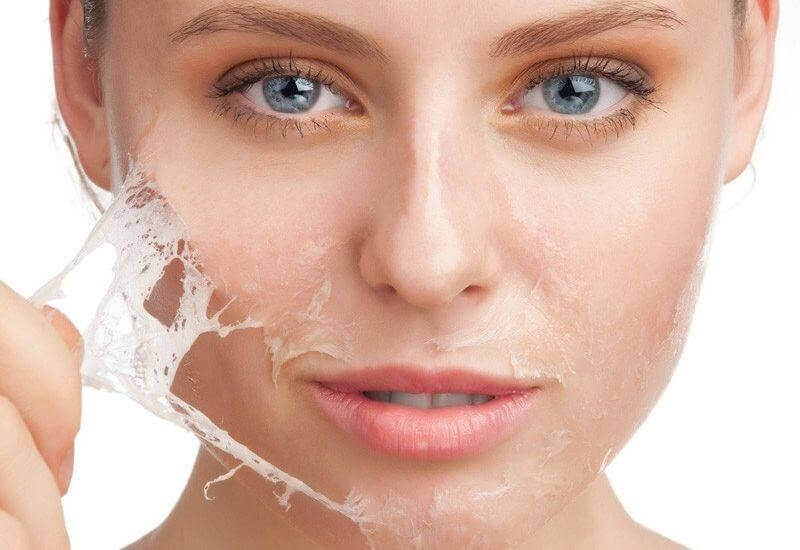Peel da hóa học là một phương pháp cải thiện nám - bị nám da mặt phải làm sao