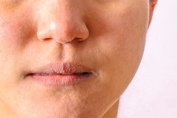 Sử dụng hoạt chất trị mụn có thể khiến da bị khô - kem trị mụn dưỡng da