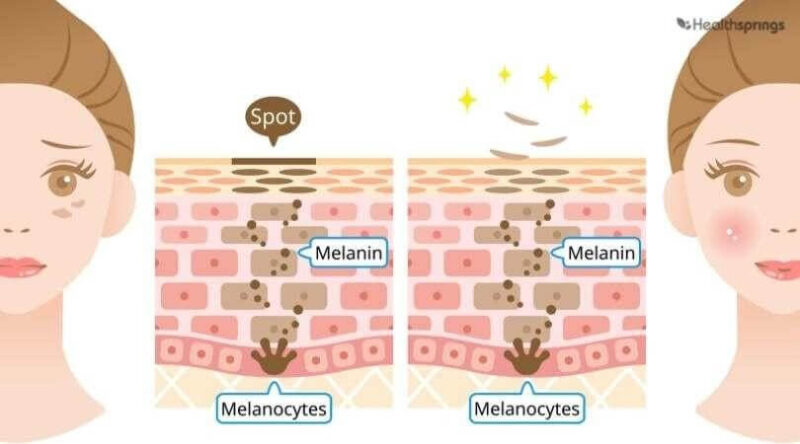 Tế bào melanocyte và sự biểu hiện sắc tố melanin trên bề mặt da - trị nám tàn nhang