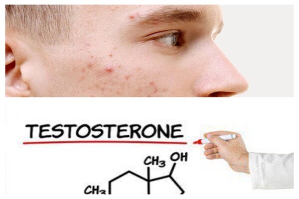 Testosterone nguyên nhân gây ra mụn ở nam - serum trị mụn cho nam