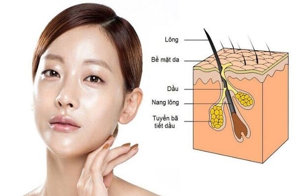Tuyến bã nhờn hoạt động quá mức là nguyên nhân gây ra mụn đầu đen