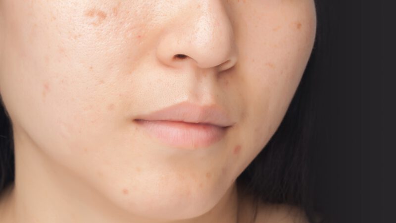 Vết thâm mụn gây mất thẩm mỹ, thiếu tự tin khi giao tiếp với mọi người